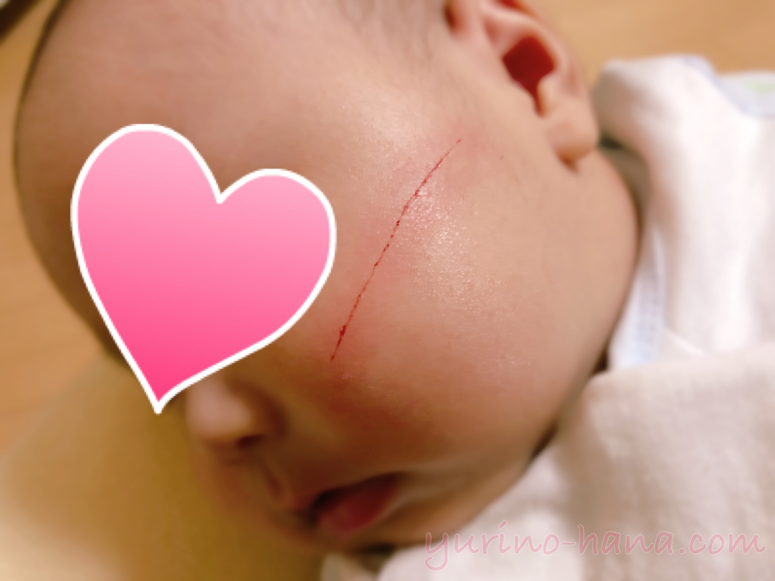 赤ちゃんの顔にできたひっかき傷 2 No 403278 写真素材なら 写真ac 無料 フリー ダウンロードok